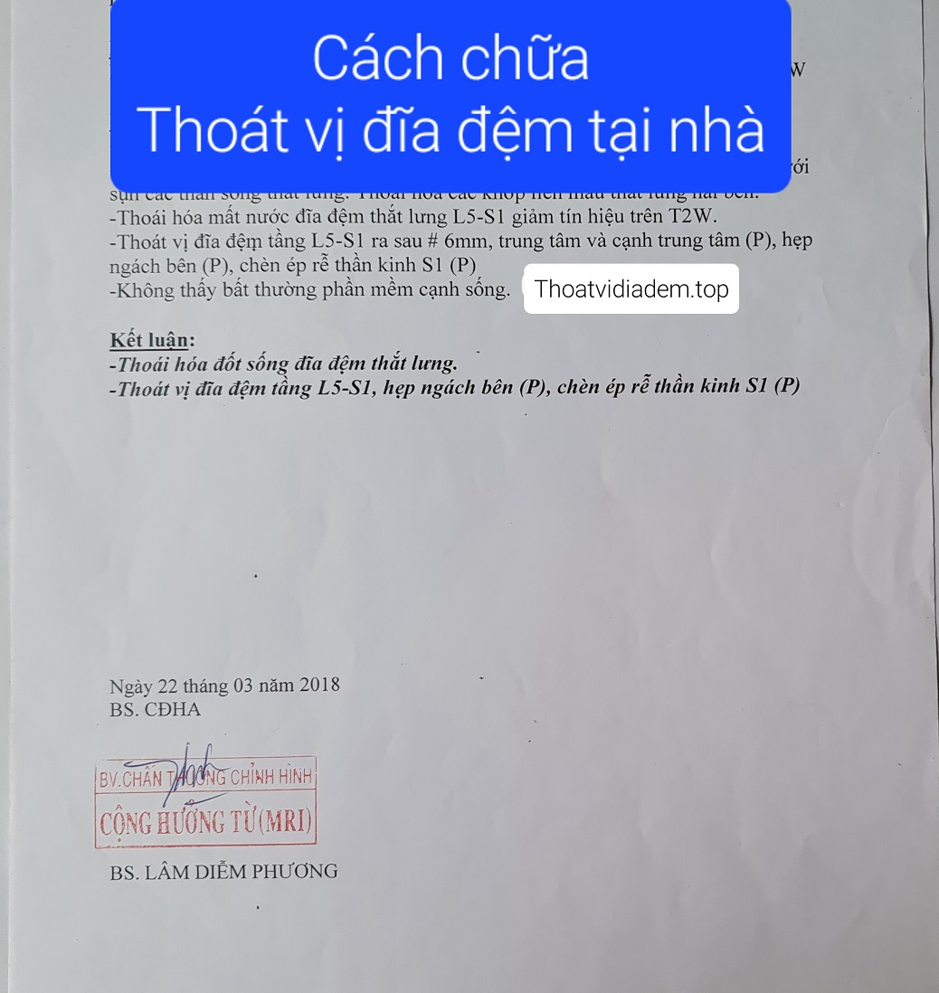 Cách chữa thoát vị đĩa đệm tại nhà